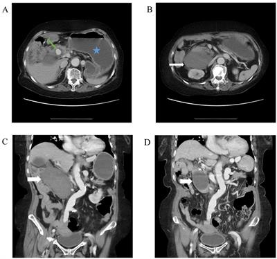 Case report: Duodenal obstruction caused by gastroduodenal artery pseudoaneurysm with hematoma: an unusual case and literature review